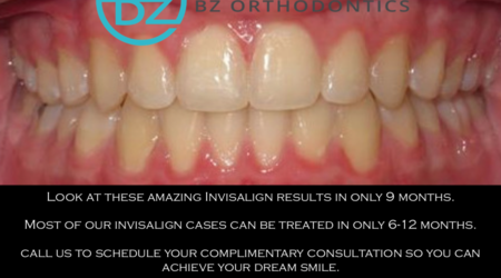 Get Your Invisalign Clear Braces at Our Ideal Smile Philadelphia Specialist