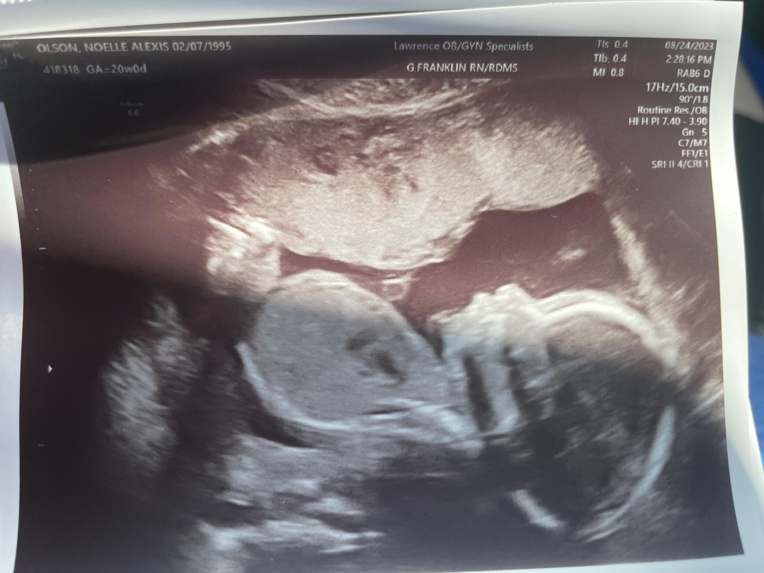 Baby Hazel at 20 weeks 
