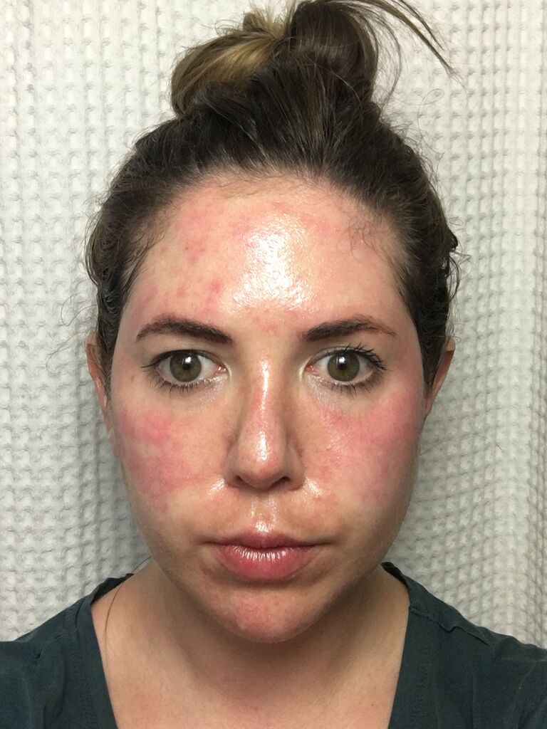 Microneedling results