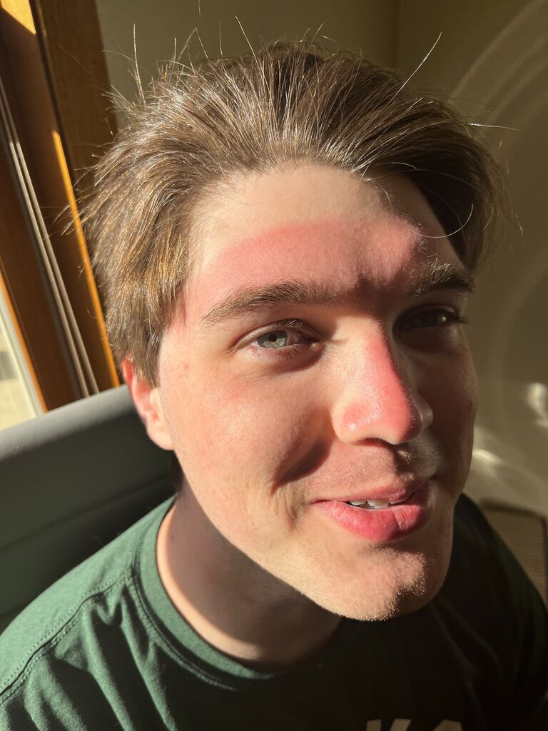 Justin receives a sunburn of a lifetime following a very sunny law graduation