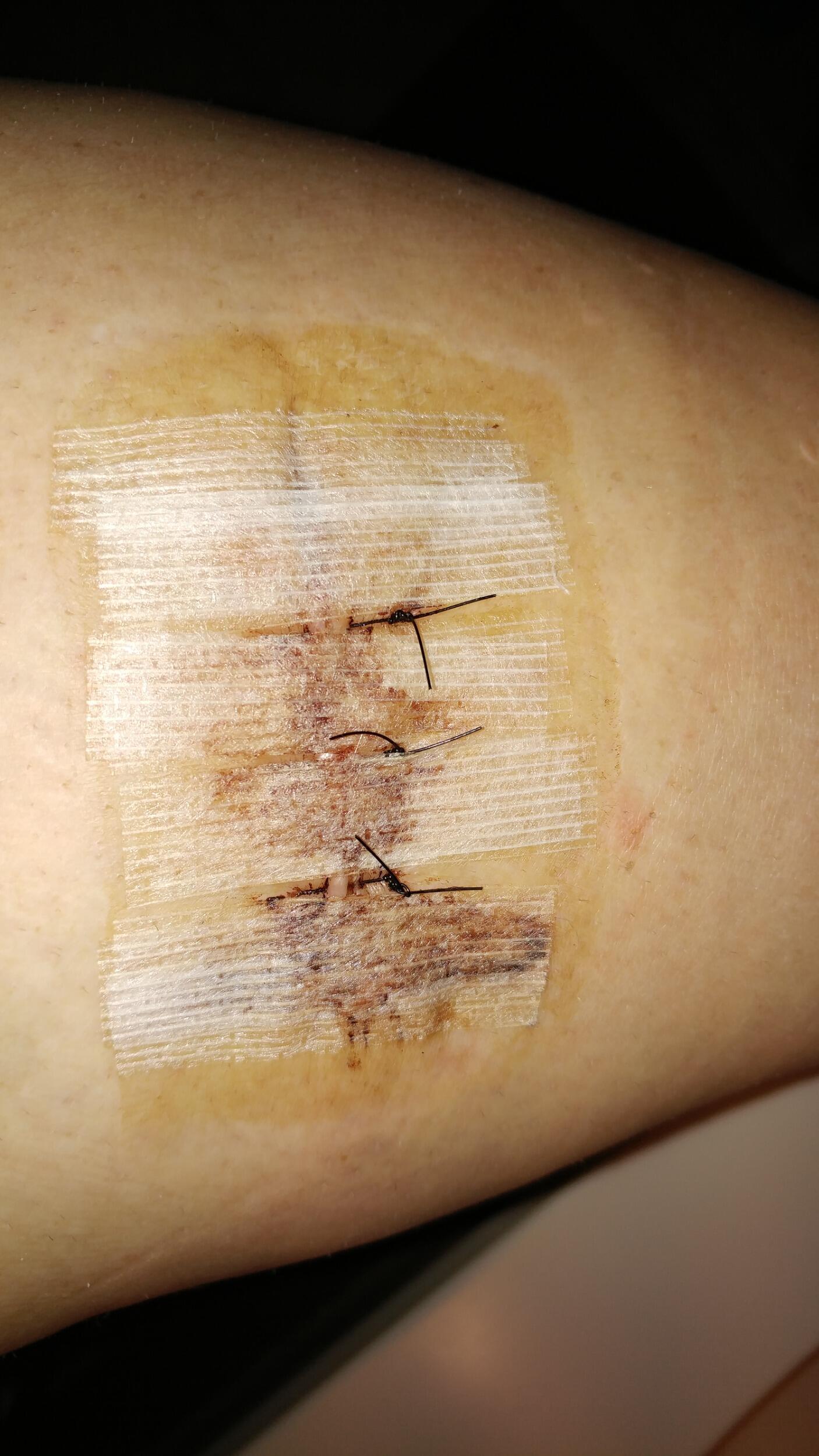 I wheeled Keith into the Oncology Center with me for this 1. Melanoma was excised off my leg. Then a chunk was taken out for more testing. Fortunately, no further treatment was needed! 🙏 (Sorry if you have a weak stomach! lol)
