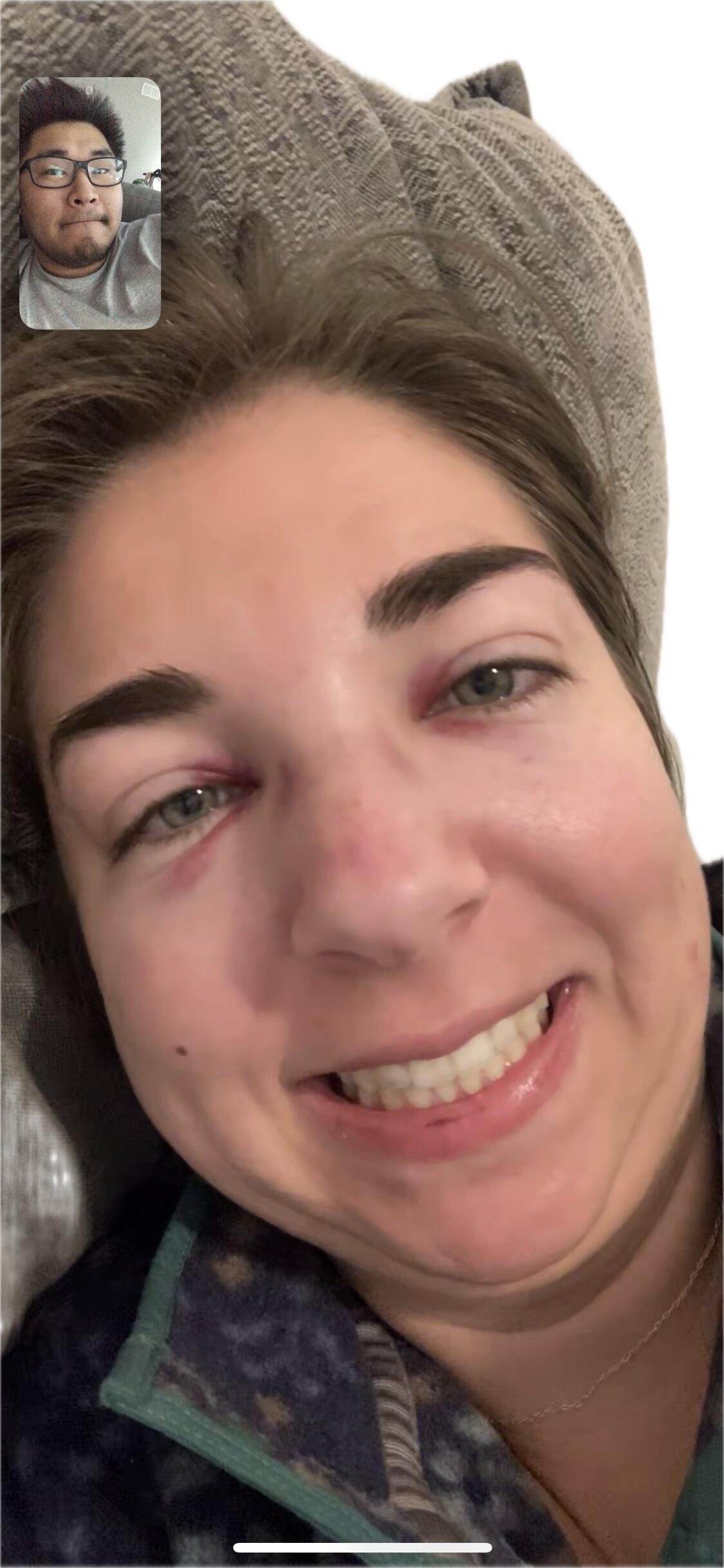 Long distance meant many hours on FaceTime! Here Abbie is telling Joey how she broke her nose 