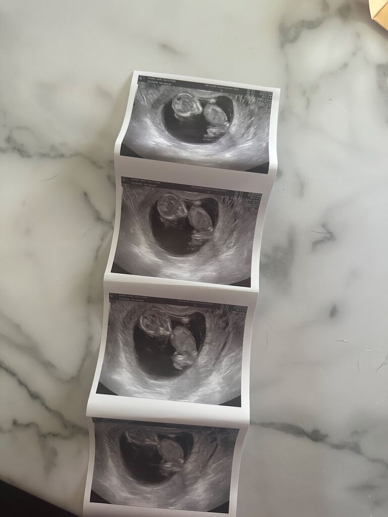 The first ultrasound photos- 12 weeks.