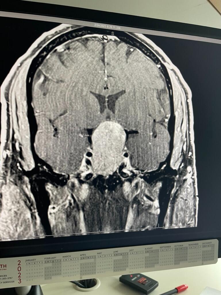 A major health issue like a brain tumor would end most young love stories, but this is no ordinary love story! When Kevin found out that he had a 4.3mm brain tumor, his 'I am good on my own' belief was severely tested. Stephanie looked into Kevin's eyes and said, "I don't want to scare you when I say this, in sickness and in health; I got you." Instead of the brain tumor ending their love story, it deepened this love story as it revealed a reliability and dependability that became the foundation of their commitment. 