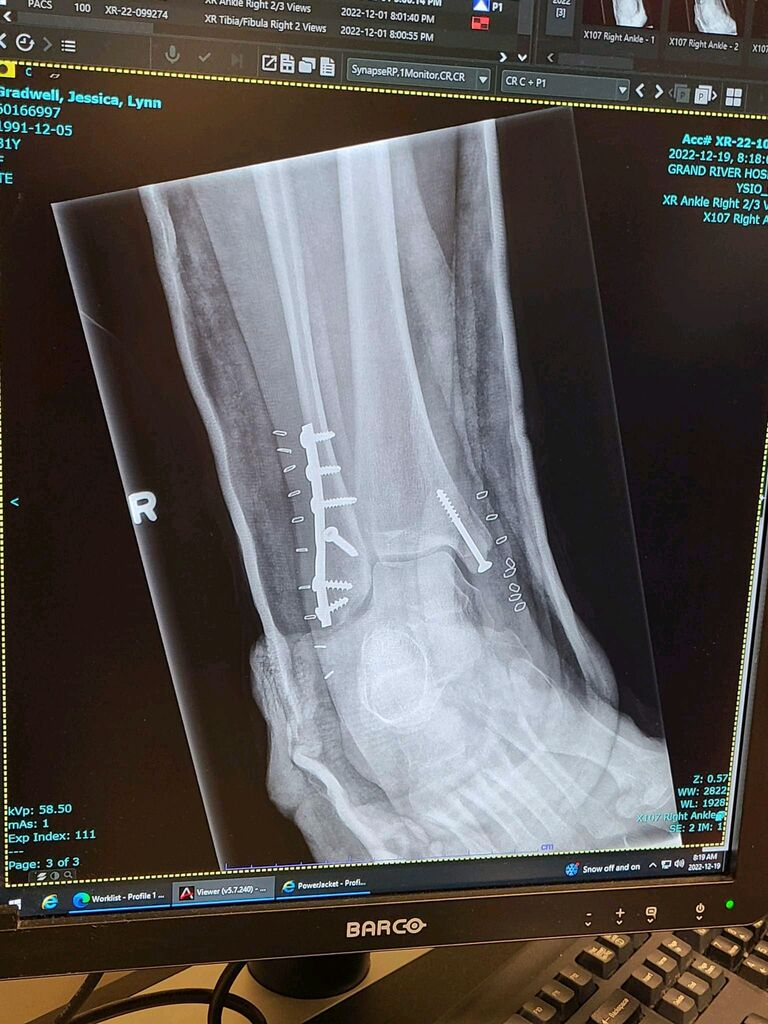 Jess needs support - the big ankle break