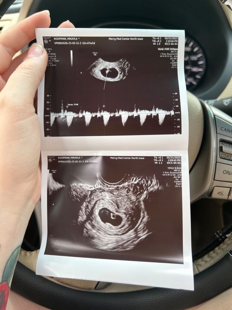 First ultrasound of our daughter
