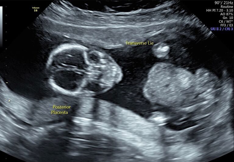 SURPRISE! Baby Graham coming Autumn 2025!
