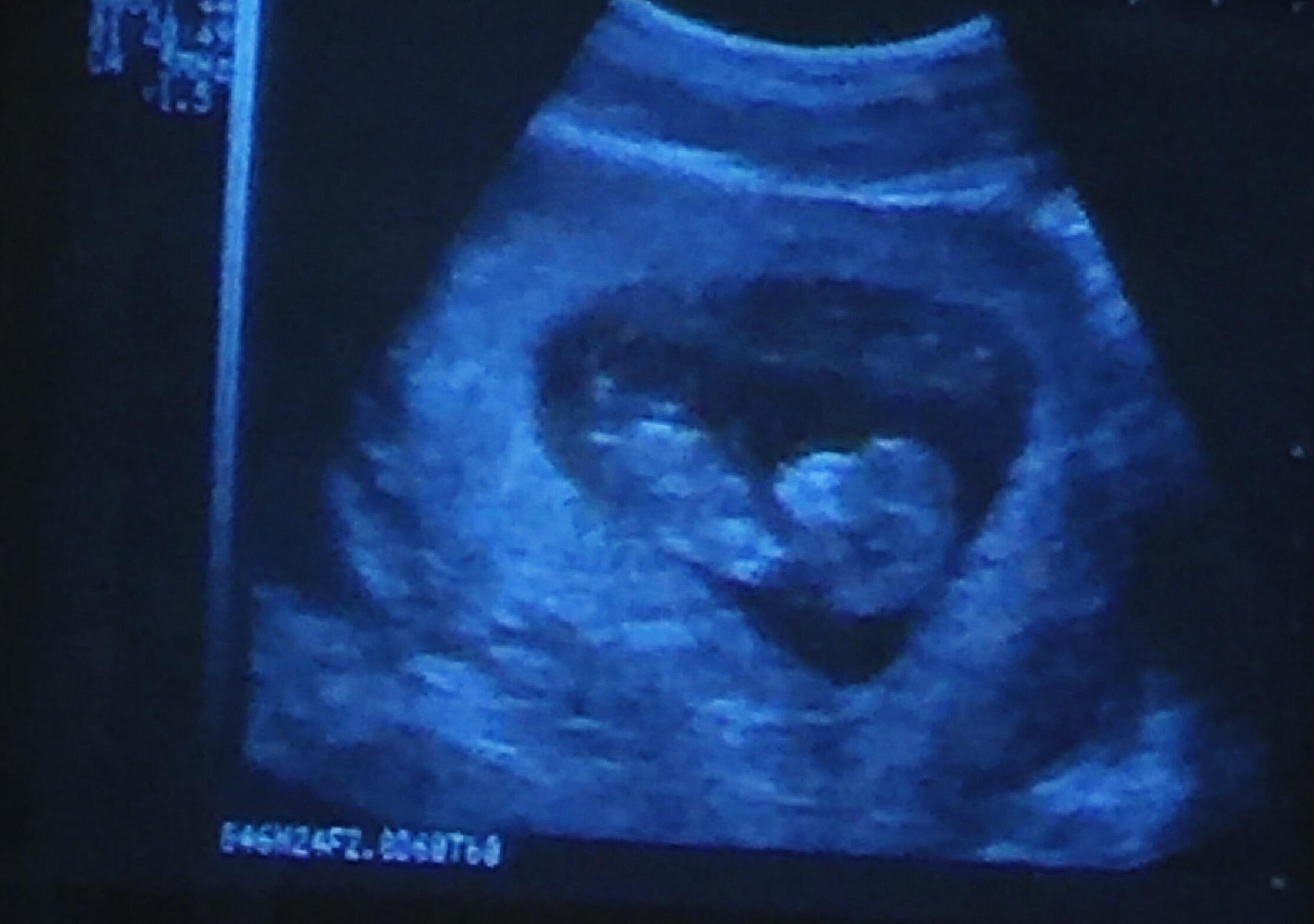 A little miracle is on the way! 